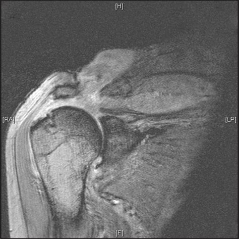 MRI scan showing a large glenohumeral joint effusion wi | Open-i