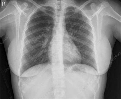 Normal Chest X Ray Images