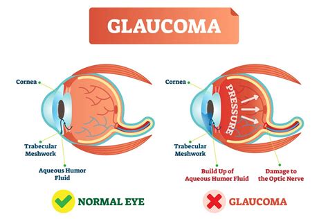 Childhood Glaucoma - Asia Retina Singapore