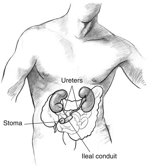 Urostomy or Urinary Diversion