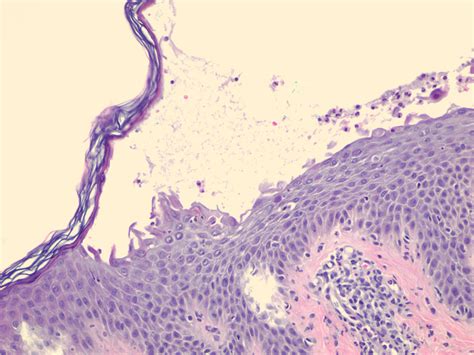 Staphylococcal scalded skin syndrome; Ritter Disease; Scalded Skin Syndrome, Staphylococcal