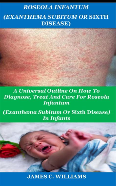 Buy ROSEOLA INFANTUM (EXANTHEMA SUBITUM OR SIXTH DISEASE): A Universal Outline On How To ...