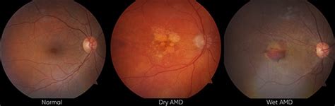 Macular Degeneration - Eye Clinic of Florida