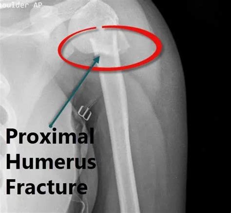 Proximal Humerus Fracture Classification