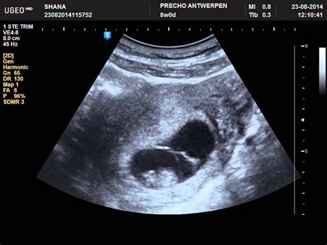 pregnant but can't see baby on ultrasound - Dorthea Spangler