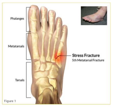 Marvelous Tips About How To Heal A Jones Fracture - Policebaby25