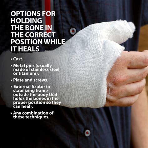 Colles' Fractures (Broken Wrist) | Florida Orthopaedic Institute