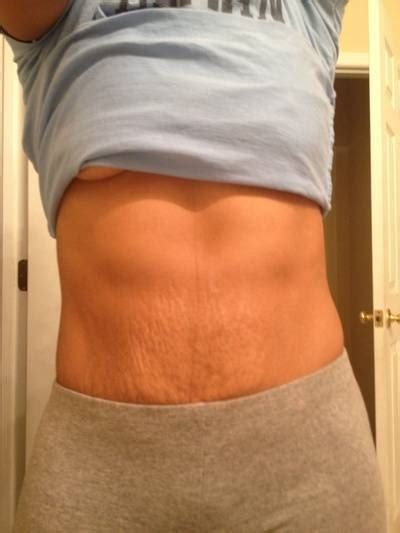 Mini tummy tuck pictures before and after New York top cosmetic surgeons shapshots » Tummy Tuck ...