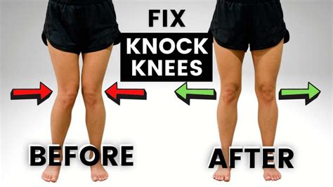 Knock Knees Causes, Treatment and Best Exercises - 2023