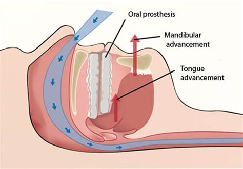 Long-term Oral Appliance Therapy Improves Daytime Function and Mood in ...