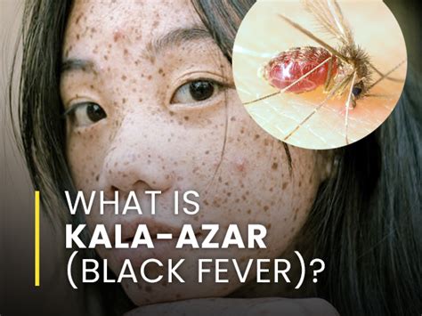 What Is Kala-Azar (Black Fever)? Causes, Symptoms, Risk Factors ...