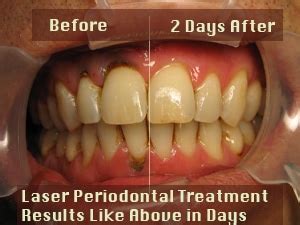 Laser Periodontal Disease - Austin Laser Dentist - Helen Ragsdale DDS