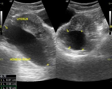 Linear Ultrasound Hydrosalpinx