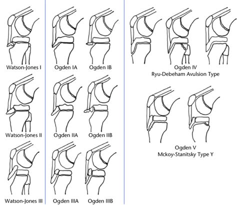 Tibial Tuberosity Ossification