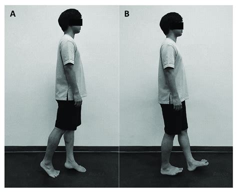 Tandem exercise. (A) Forward movement; (B) Backward movement. | Download Scientific Diagram