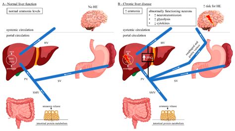 JCM | Free Full-Text | Shunt-Induced Hepatic Encephalopathy in TIPS ...