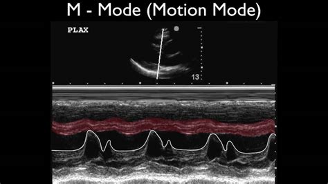 M Mode Ultrasound Definition