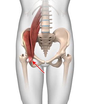 Iliopsoas Tendonitis Treatment Naples FL | Groin Pain Fort Myers, Bonita Springs Hip Trauma