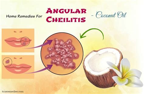 25 Natural Home Remedies For Angular Cheilitis Infection Fast