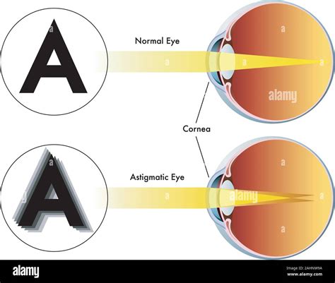 What Is Astigmatism Astigmatism Test Astigmatism Symptoms | Images and Photos finder