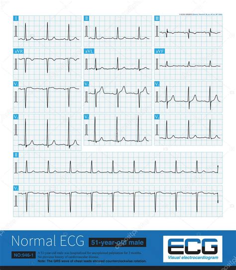 Note that the V3 lead of this ECG shows that the amplitude of R wave is ...