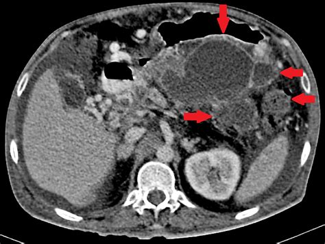 Cureus | Mediastinal Eventration of a Pseudocyst of Pancreas Presenting As Acute Shock Syndrome ...