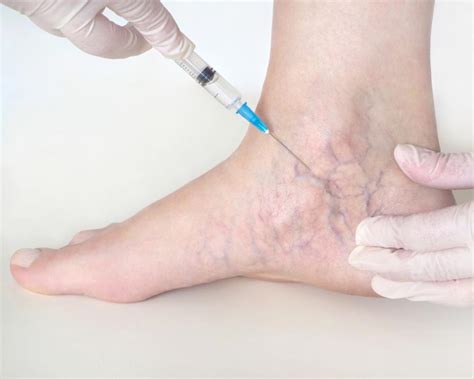 Spider and Varicose Veins Treatments: Sclerotherapy FAQs | Vein Center in Walnut Creek ...