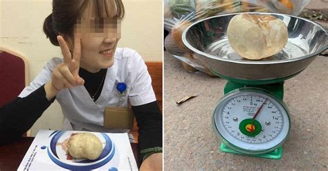 Batu Kandung Kemih Seberat 400 Gram Diangkat dari Kandung Kemih Seorang Wanita di Vietnam ...