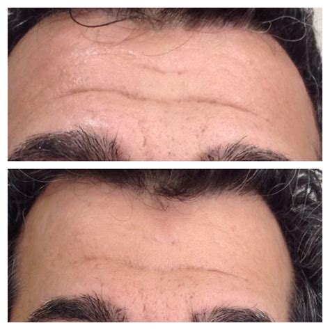 eDermaStamp® by Dermaroller® | Dermaroller® Micro-Needling | Collagen Induction Therapy