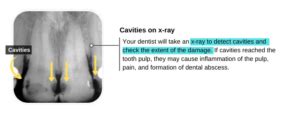 Cavities in Front Teeth: Causes & Treatment Options - Share Dental Care