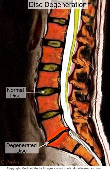 7 Lumbar Degenerative Disc Disease shown on Color X-Ray and MRI ideas | degenerative disc ...