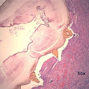 CDC - DPDx - Myiasis