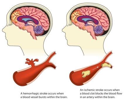 Types of Stroke | Disease Prevention and Healthy Lifestyles