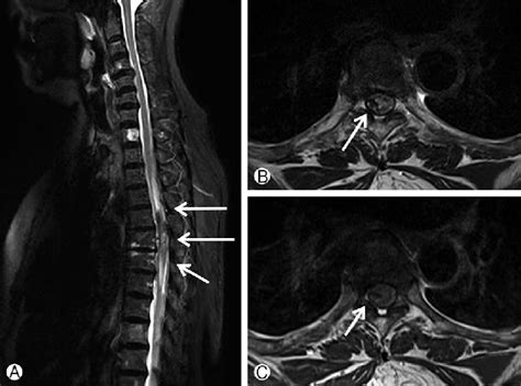 Initial Magnetic resonance imaging (MRI) of the thoracic spine... | Download Scientific Diagram