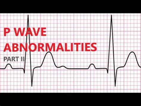 P Wave Abnormalities Part II - YouTube