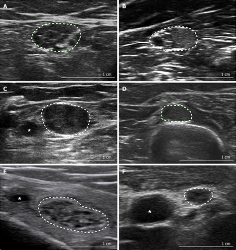 Wrist Ultrasound