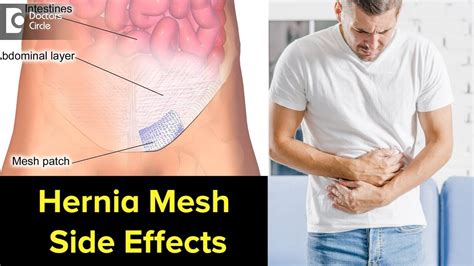 How Do You Know If You Have Hernia Mesh Complications