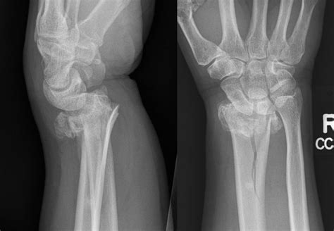 Distal Radius Fractures | Simcoe-Muskoka Orthopaedics