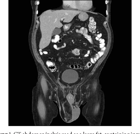 Figure 1 from Liposarcoma of the Spermatic Cord Masquerading as an ...