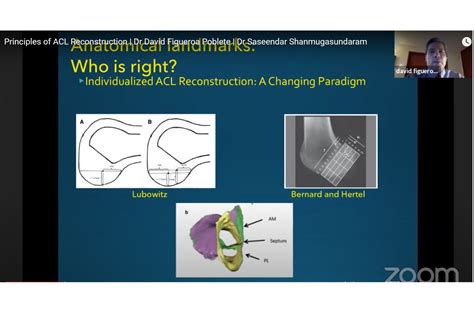 Principles of ACL Reconstruction — OrthopaedicPrinciples.com