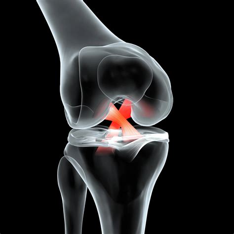 ACL Injury Symptoms and Treatments • Dr. Paul Miano