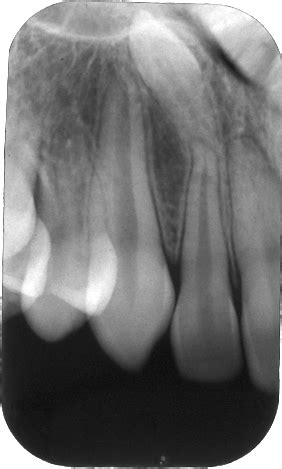 Case of the Week: Mesiodens – Dr. G's Toothpix