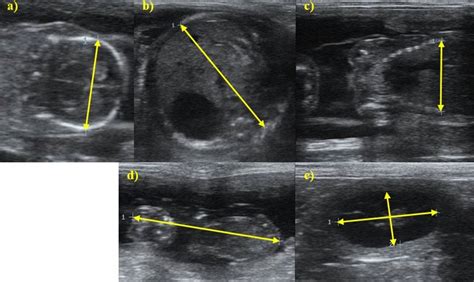 Ultrasound images of the measurements taken in fetal and non-fetal ...