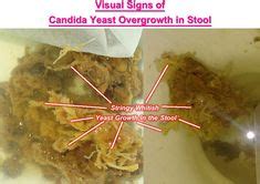 Candida In Stool Symptoms - Stools Item