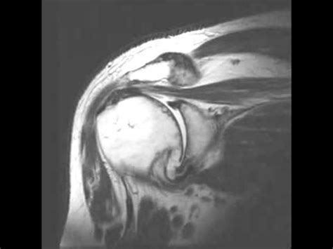 Shoulder osteoarthritis MRI coronal.mp4 - YouTube