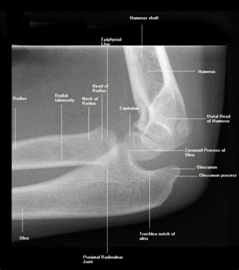 Lateral X-ray of elbow Pa School, Tech School, School Help, Nursing School, Brain Anatomy ...