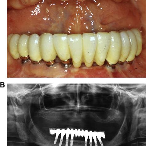 a & 3b: Subepithelial connective tissue graft procedure. (a) Donor ...