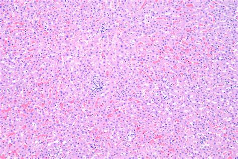 Pathology cases — Focal hepatocellular necrosis – Billoblog