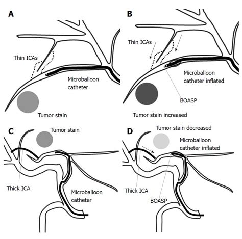 Balloon-occluded transcatheter arterial chemoembolization for hepatocellular carcinoma