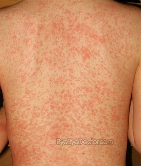 Heat Rash – Symptoms, Treatment, Pictures, Cure, Remedies